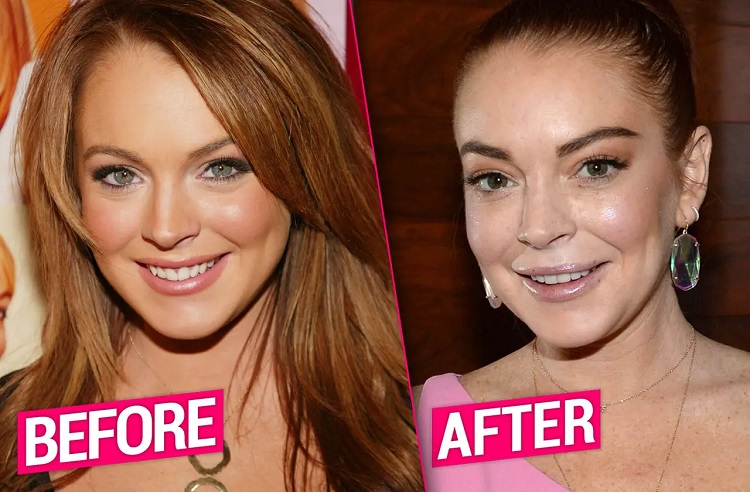 Lindsay Lohan has undergone surgery, say multiple experts.