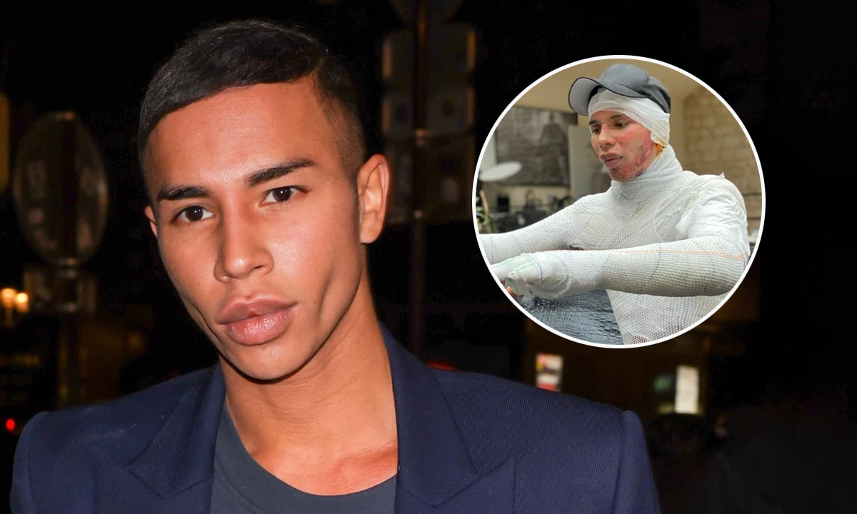Olivier Rousteing Met with a Horrific Accident That Could Have Been Life-Threatening