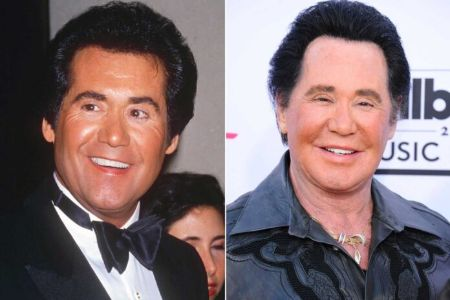 Wayne Newton before and after his alleged plastic surgery