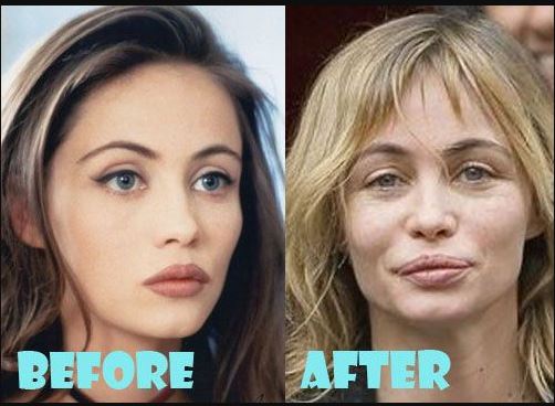 Emmanuelle Beart before and after plastic surgery