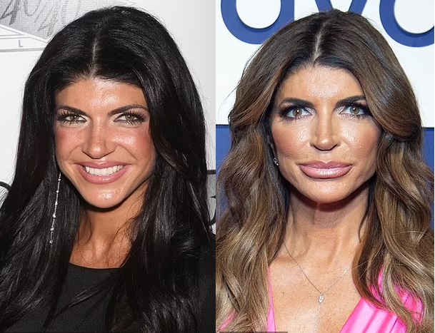 Teresa Giudice before and after the alleged forehead lengthening surgery